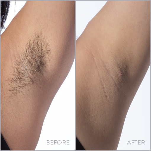 Lip and Chin Laser Hair Removal Photo, Before & After